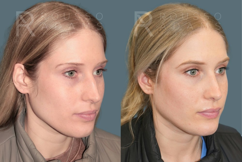 Rhinoplasty<span class=small>By Dr. Austin Adams</span> Before & After Gallery - Patient 299268 - Image 3
