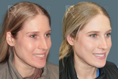 Rhinoplasty<span class=small>By Dr. Austin Adams</span> Before & After Gallery - Patient 299268 - Image 4