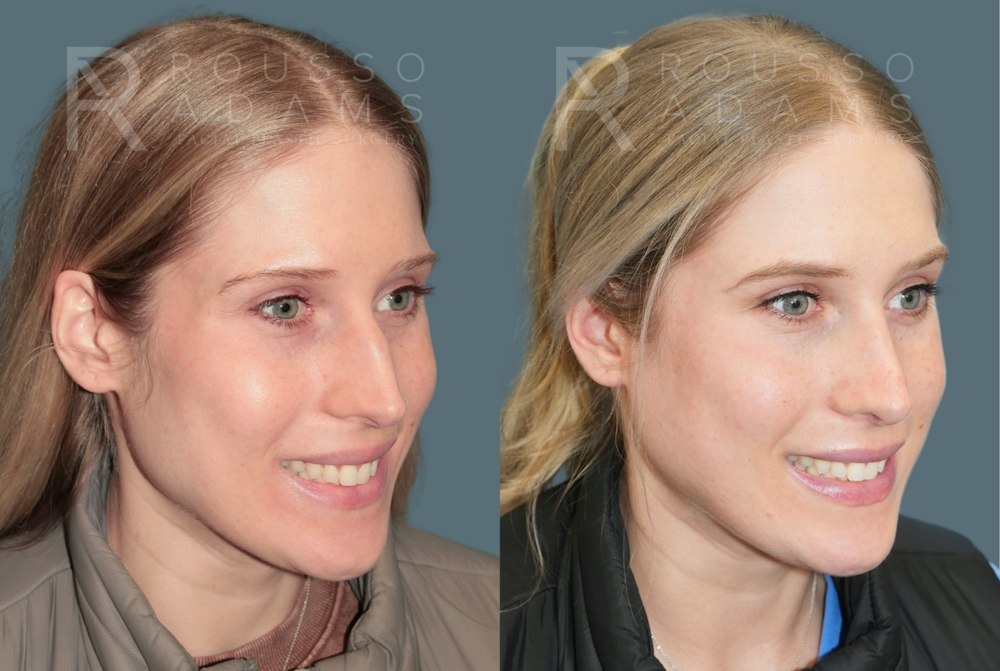 Rhinoplasty<span class=small>By Dr. Austin Adams</span> Before & After Gallery - Patient 299268 - Image 4