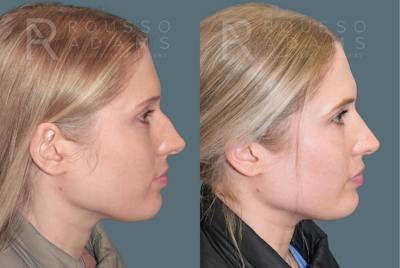 Rhinoplasty<span class=small>By Dr. Austin Adams</span> Before & After Gallery - Patient 299268 - Image 1