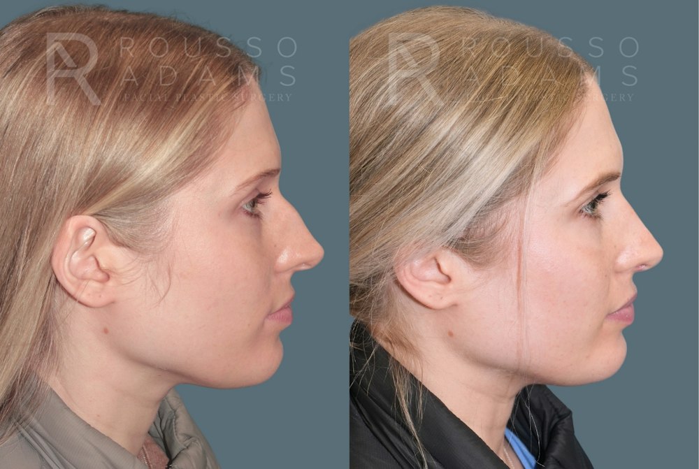 Rhinoplasty<span class=small>By Dr. Austin Adams</span> Before & After Gallery - Patient 299268 - Image 1