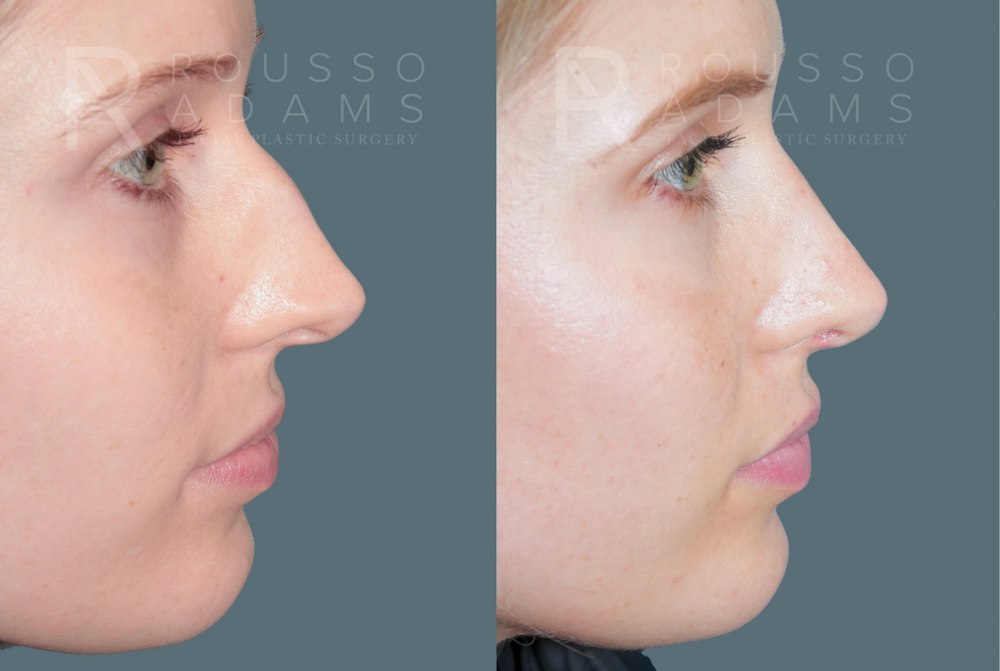 Rhinoplasty<span class=small>By Dr. Austin Adams</span> Before & After Gallery - Patient 299268 - Image 6