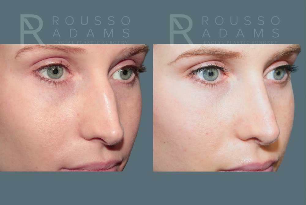 Rhinoplasty<span class=small>By Dr. Austin Adams</span> Before & After Gallery - Patient 299268 - Image 5