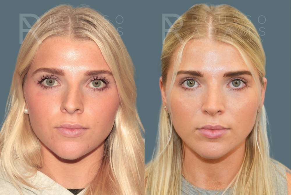 Rhinoplasty<span class=small>By Dr. Austin Adams</span> Before & After Gallery - Patient 973020 - Image 3