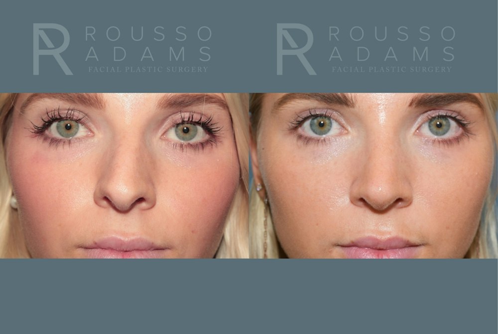 Rhinoplasty<span class=small>By Dr. Austin Adams</span> Before & After Gallery - Patient 973020 - Image 5