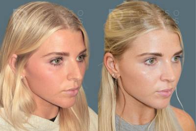 Rhinoplasty<span class=small>By Dr. Austin Adams</span> Before & After Gallery - Patient 973020 - Image 2