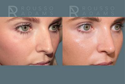Rhinoplasty<span class=small>By Dr. Austin Adams</span> Before & After Gallery - Patient 973020 - Image 4