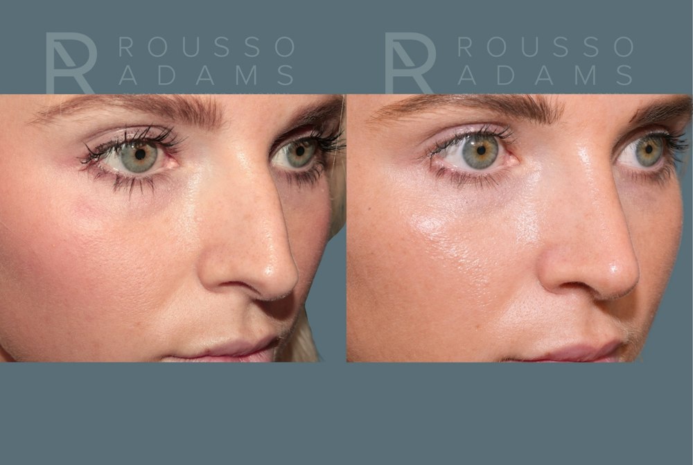 Rhinoplasty<span class=small>By Dr. Austin Adams</span> Before & After Gallery - Patient 973020 - Image 4