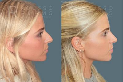 Rhinoplasty<span class=small>By Dr. Austin Adams</span> Before & After Gallery - Patient 973020 - Image 1
