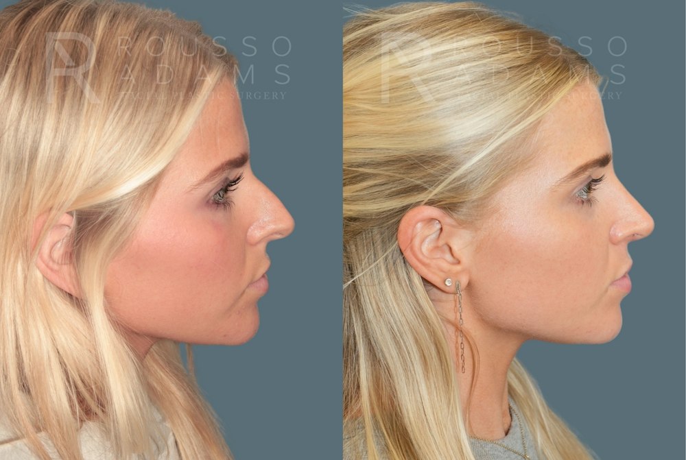 Rhinoplasty<span class=small>By Dr. Austin Adams</span> Before & After Gallery - Patient 973020 - Image 1