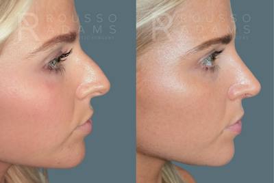 Rhinoplasty<span class=small>By Dr. Austin Adams</span> Before & After Gallery - Patient 973020 - Image 6