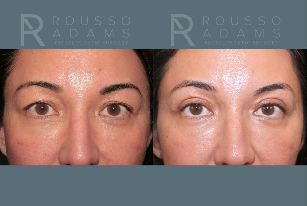 Blepharoplasty<span class=small>By Dr. Austin Adams</span> Before & After Gallery - Patient 181832 - Image 1
