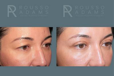 Blepharoplasty<span class=small>By Dr. Austin Adams</span> Before & After Gallery - Patient 181832 - Image 4