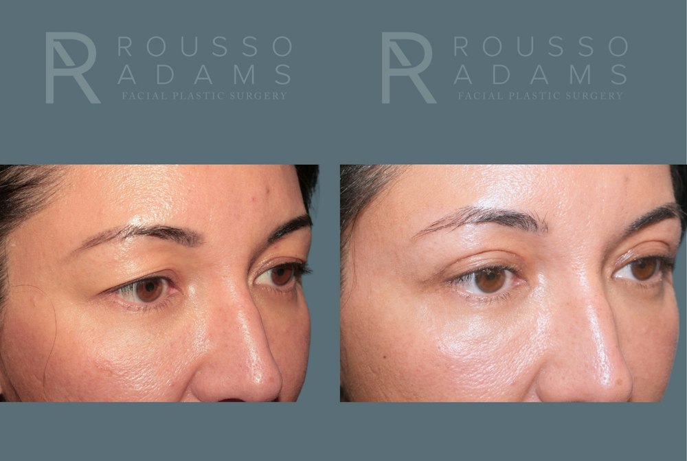 Blepharoplasty<span class=small>By Dr. Austin Adams</span> Before & After Gallery - Patient 181832 - Image 4