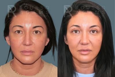 Blepharoplasty<span class=small>By Dr. Austin Adams</span> Before & After Gallery - Patient 181832 - Image 2