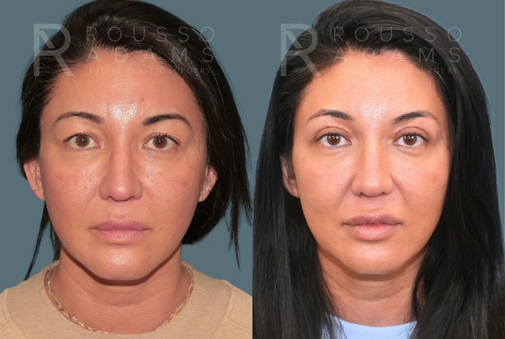 Blepharoplasty<span class=small>By Dr. Austin Adams</span> Before & After Gallery - Patient 181832 - Image 2