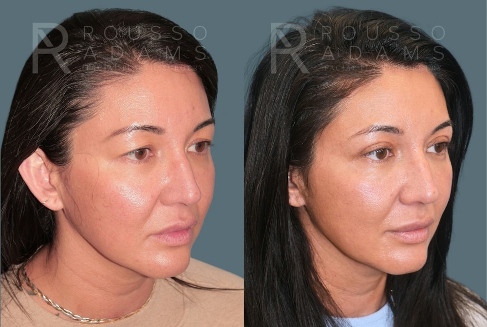 Blepharoplasty<span class=small>By Dr. Austin Adams</span> Before & After Gallery - Patient 181832 - Image 3