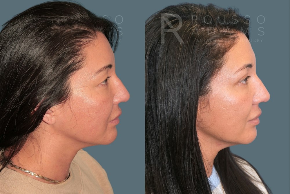 Blepharoplasty<span class=small>By Dr. Austin Adams</span> Before & After Gallery - Patient 181832 - Image 5