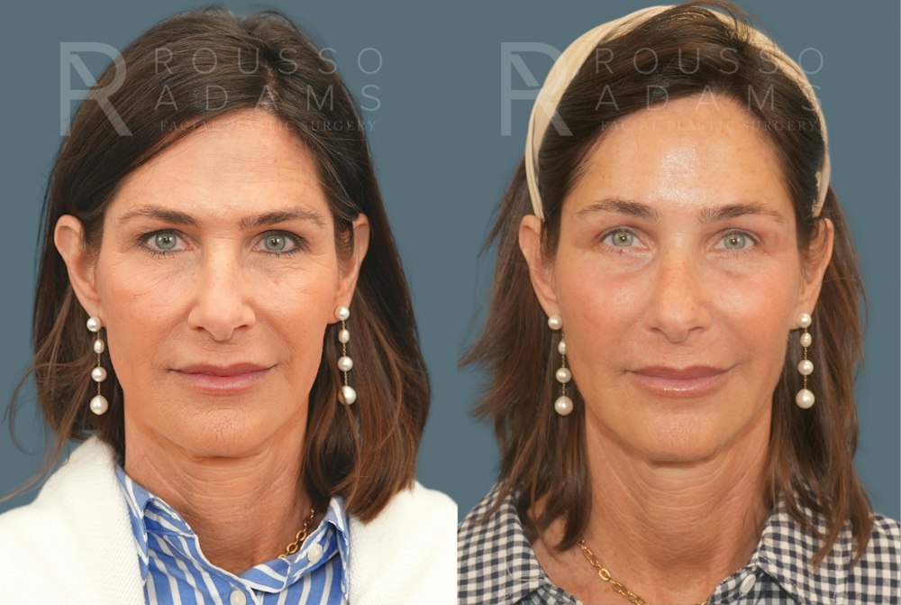 Brow Lift and Hairline Advancement<span class=small>By Dr. Austin Adams</span> Before & After Gallery - Patient 102628 - Image 1