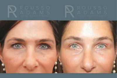 Blepharoplasty<span class=small>By Dr. Austin Adams</span> Before & After Gallery - Patient 534339 - Image 1