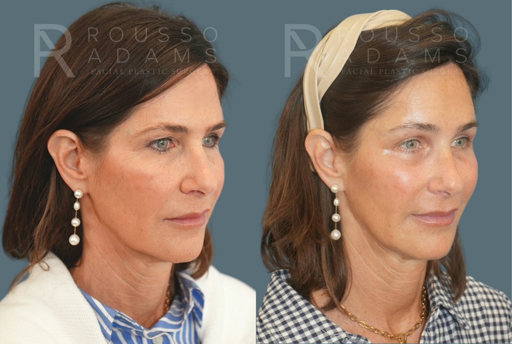 Brow Lift and Hairline Advancement<span class=small>By Dr. Austin Adams</span> Before & After Gallery - Patient 102628 - Image 2