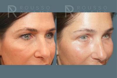 Blepharoplasty<span class=small>By Dr. Austin Adams</span> Before & After Gallery - Patient 534339 - Image 4