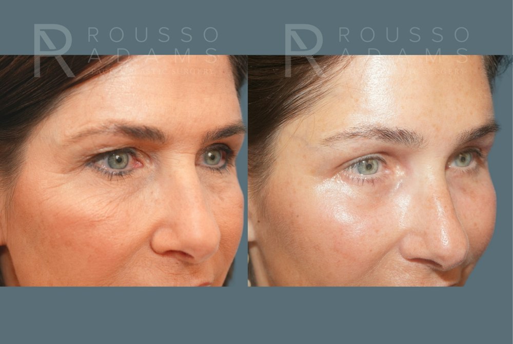 Brow Lift and Hairline Advancement<span class=small>By Dr. Austin Adams</span> Before & After Gallery - Patient 102628 - Image 5