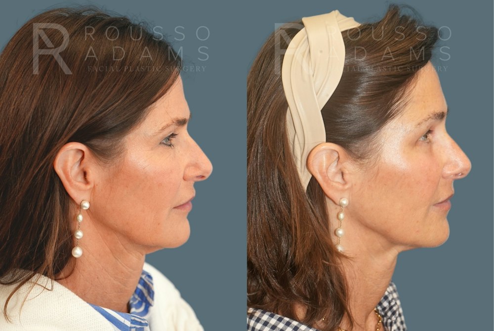 Brow Lift and Hairline Advancement<span class=small>By Dr. Austin Adams</span> Before & After Gallery - Patient 102628 - Image 3