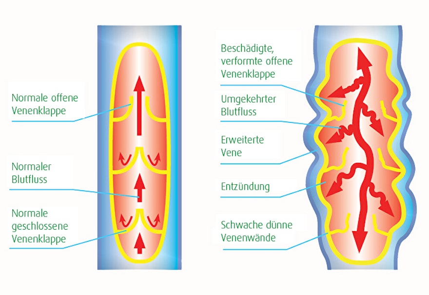 Grafik mit normaler und geschwächter Vene