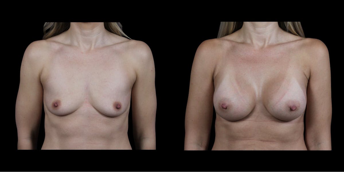 Breast Augmentation Before & After Gallery - Patient 416698 - Image 1