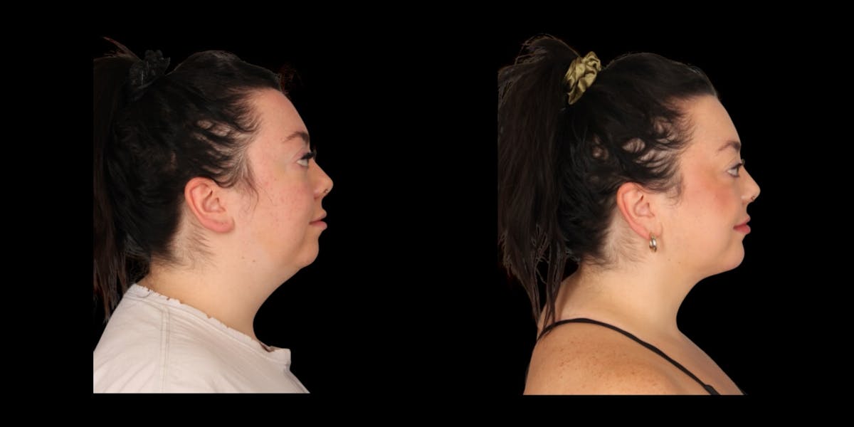 Chin Augmentation Before & After Gallery - Patient 317624 - Image 1