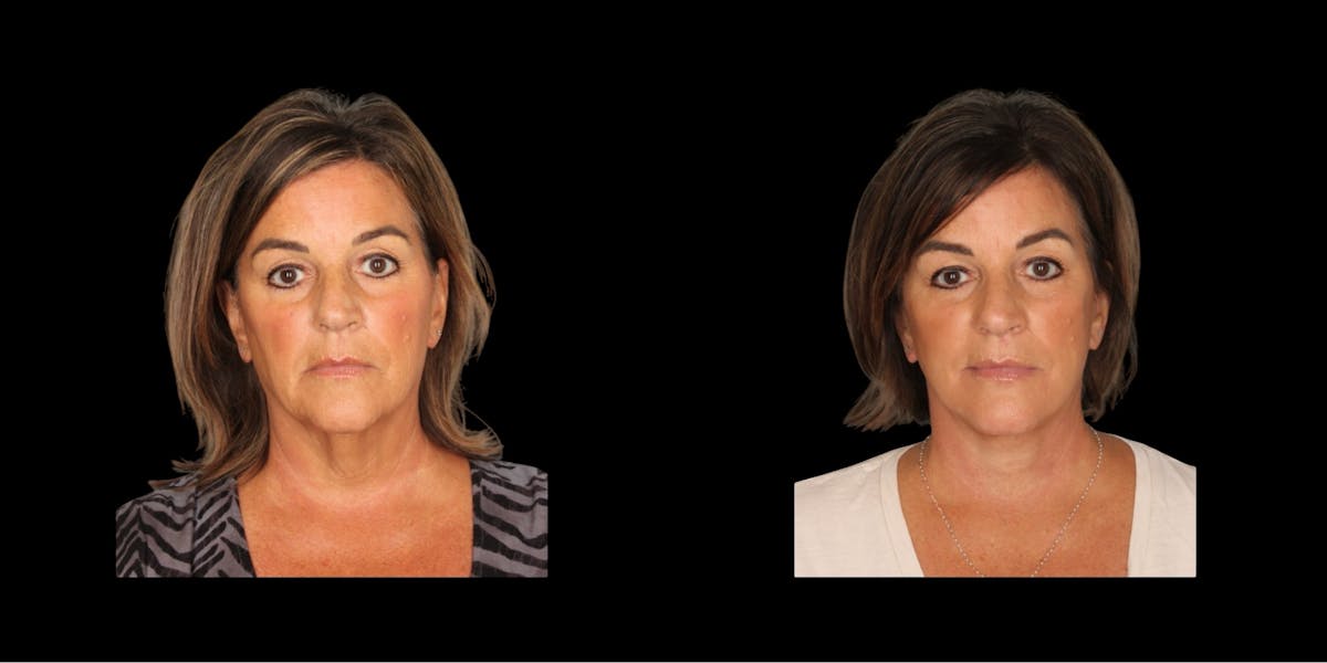 Face & Neck Lift Before & After Gallery - Patient 329056 - Image 1