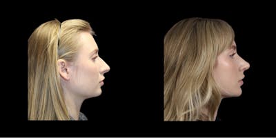 Rhinoplasty Before & After Gallery - Patient 260992 - Image 1