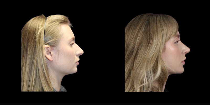 Rhinoplasty Before & After Gallery - Patient 260992 - Image 1