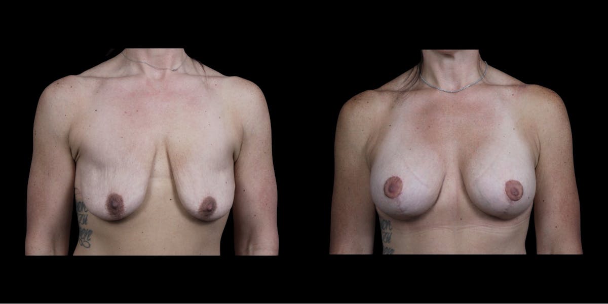 Breast Augmentation Before & After Gallery - Patient 126436 - Image 1