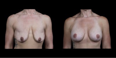 Breast Augmentation Before & After Gallery - Patient 126436 - Image 1