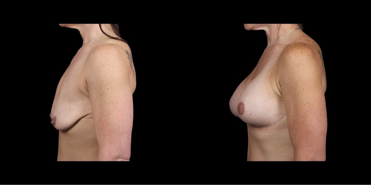 Breast Augmentation Before & After Gallery - Patient 126436 - Image 2
