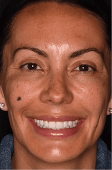 After dental treatment