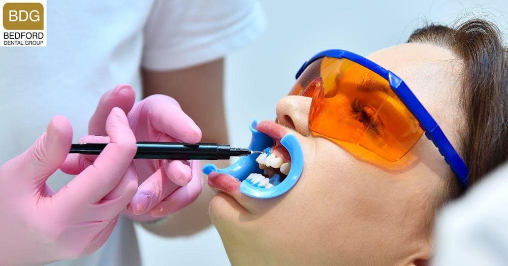 Cheaper Alternatives to Veneers - Teeth whitening