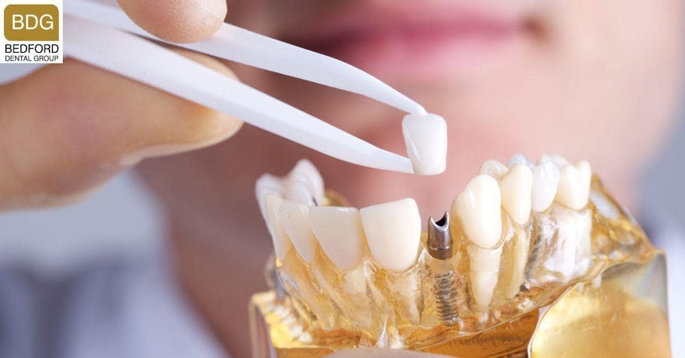 Other Alternatives to Veneers - dental implants