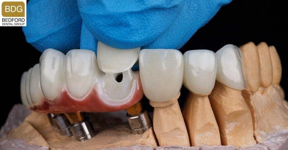 What Are Front Teeth Veneers?
