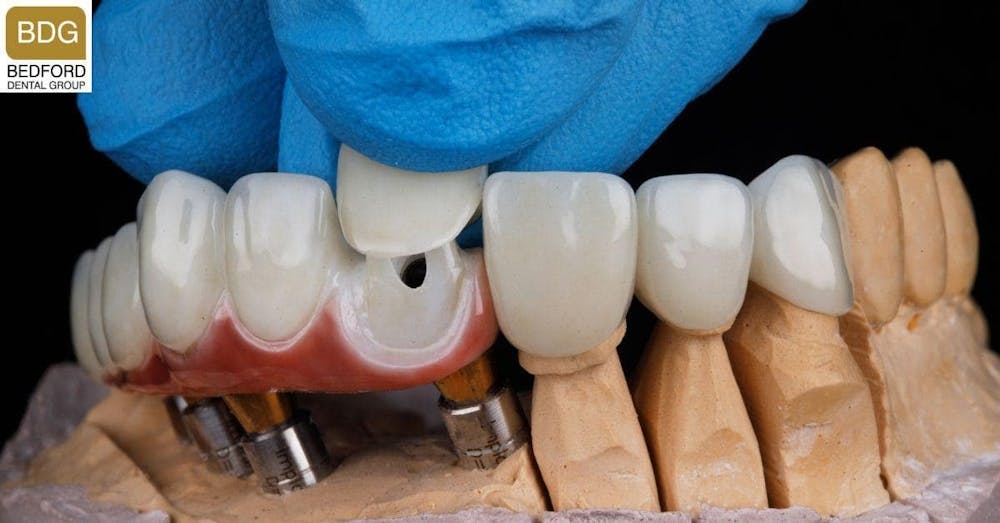 What Are Front Teeth Veneers?