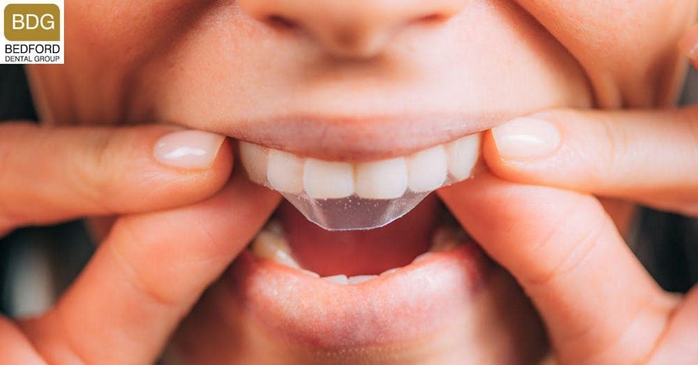 Zoom Teeth Whitening Cost vs Other Alternatives