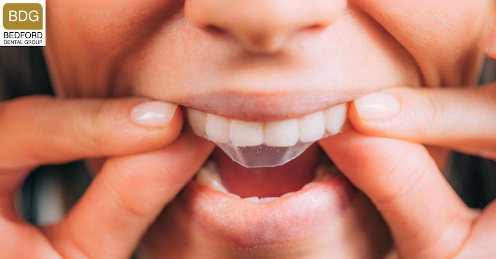 Over-the-Counter Whitening Products - Cost and Benefits