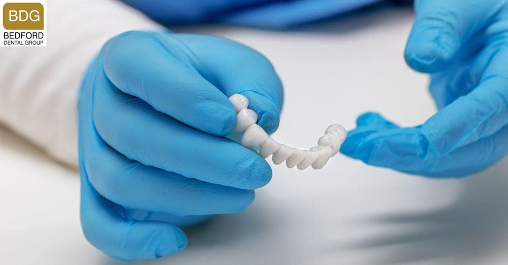 What are Dental Bridges?