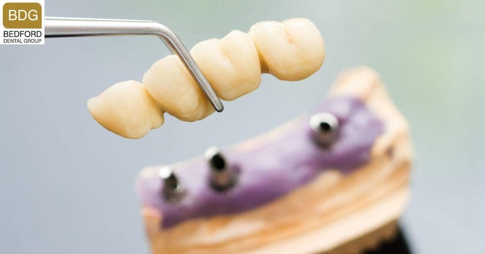 Dental Implants Vs Dental Bridges?