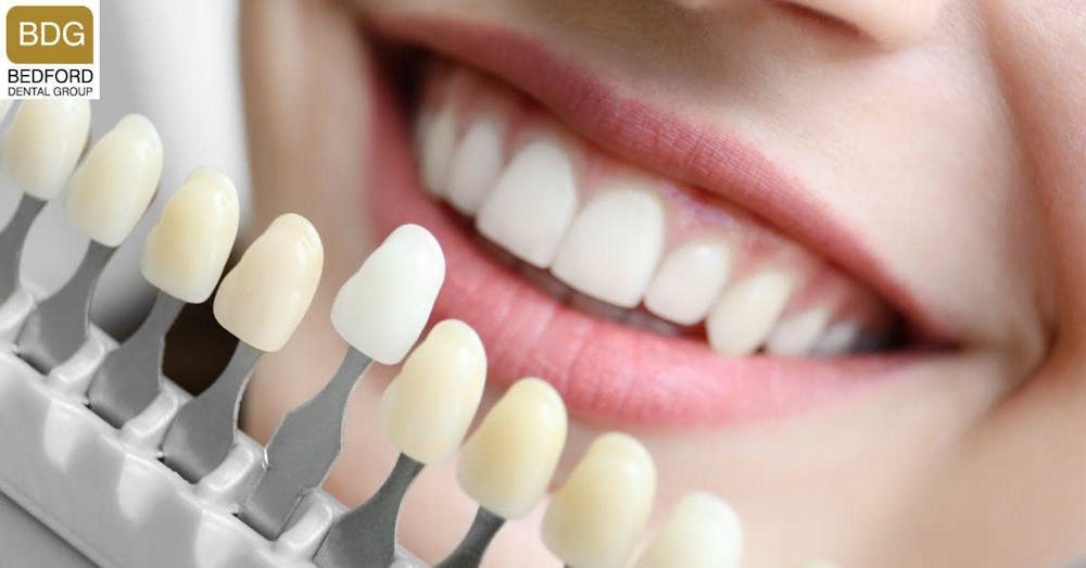 How Common is it For Veneers to Come Off?