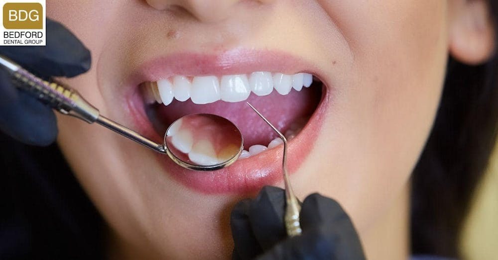 veneers by cosmetic dentists