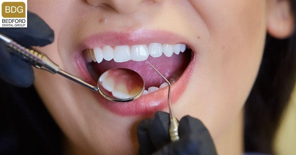 veneers by cosmetic dentists