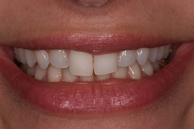 Patient Smile Before & After Gallery - Patient 619348 - Image 1